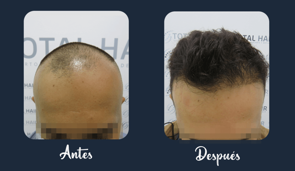 Hair implant result patient 1 1