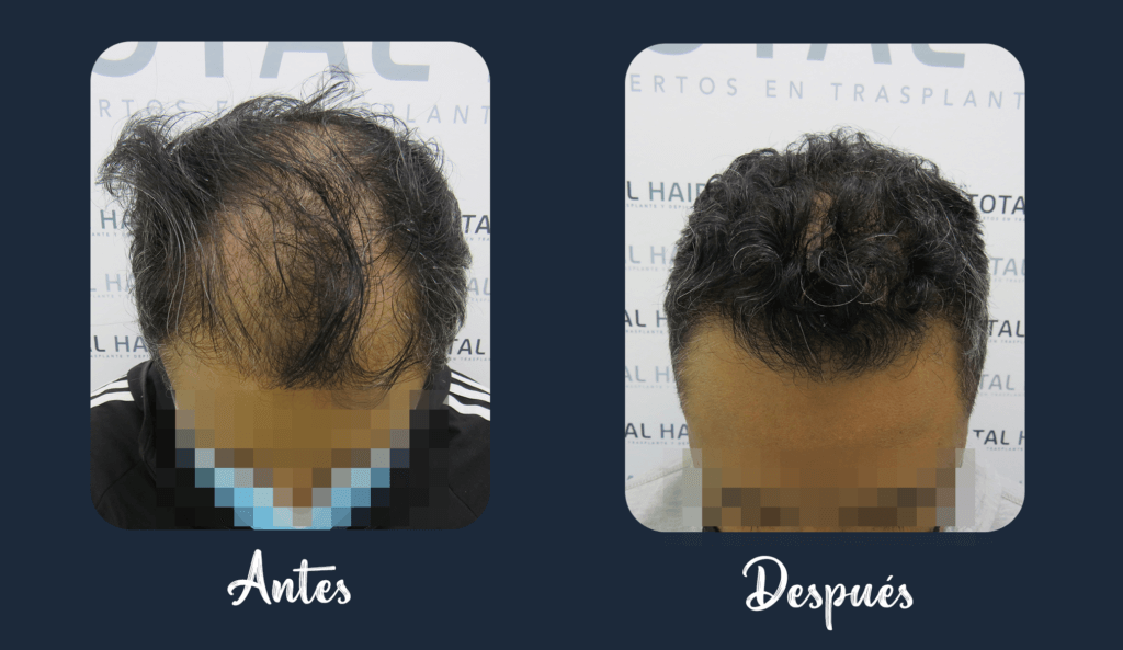 Result of hair implant patient 10 5