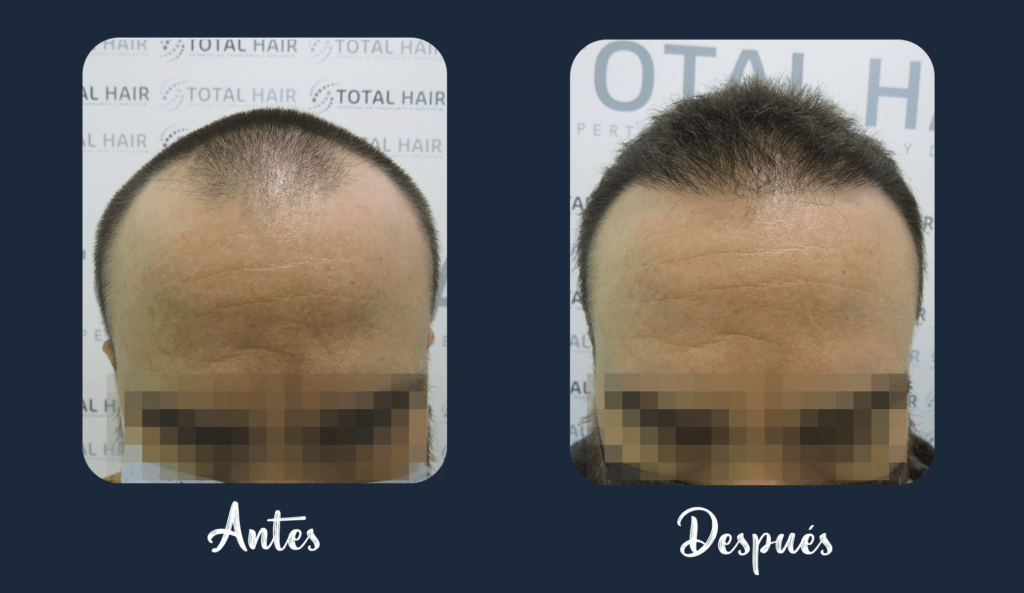 Hair implant result patient 9 4