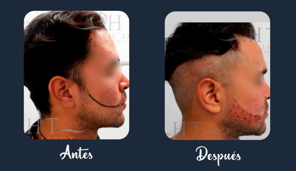 Resultado implante de barba antes y después paciente 11 1