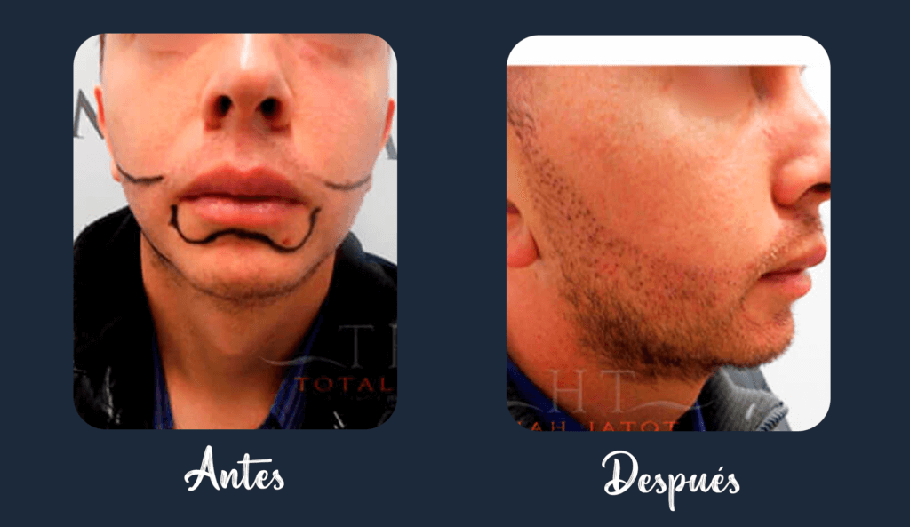 Implante de barba Medellín 2