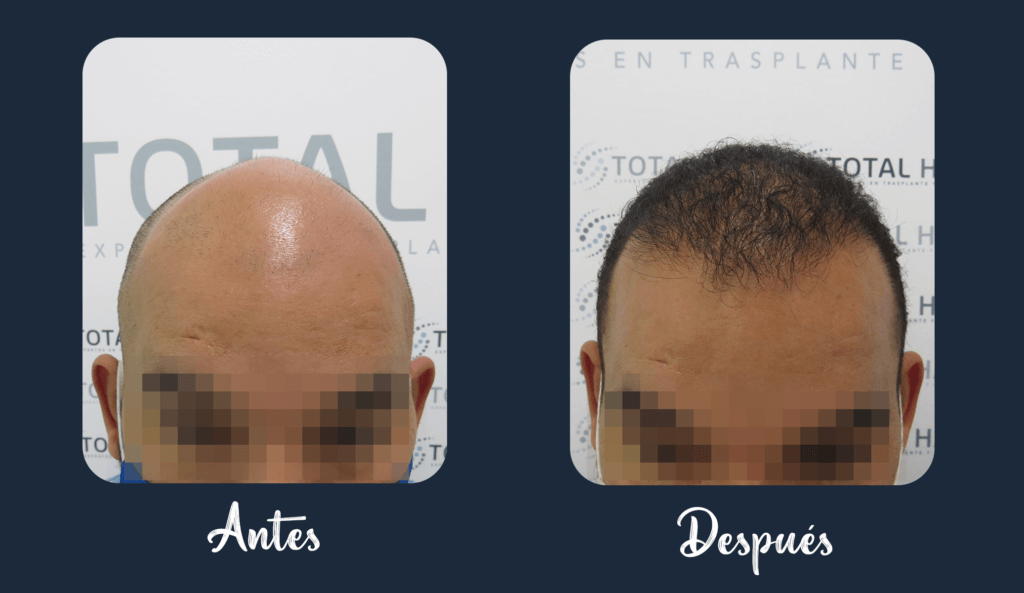 Result of hair implant patient 7 6