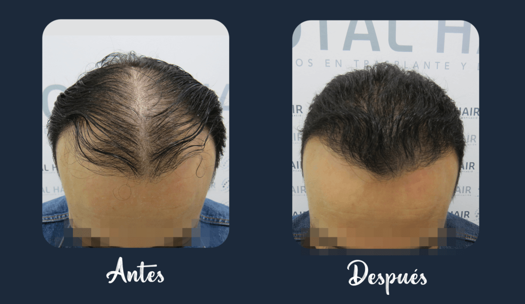 Result of hair implant patient 5 3