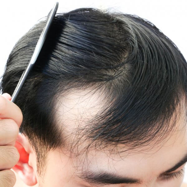 Cómo evitar la caída del cabello en hombres