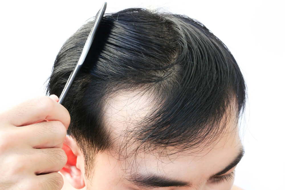 Cómo evitar la caída del cabello en hombres