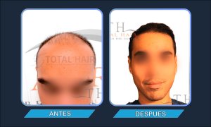 Resultados implante de pelo hombre antes y después paciente 9