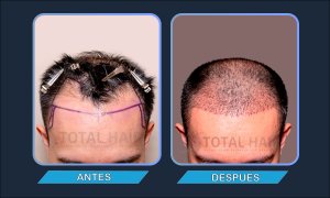 Resultados implante de pelo hombre antes y después paciente 5