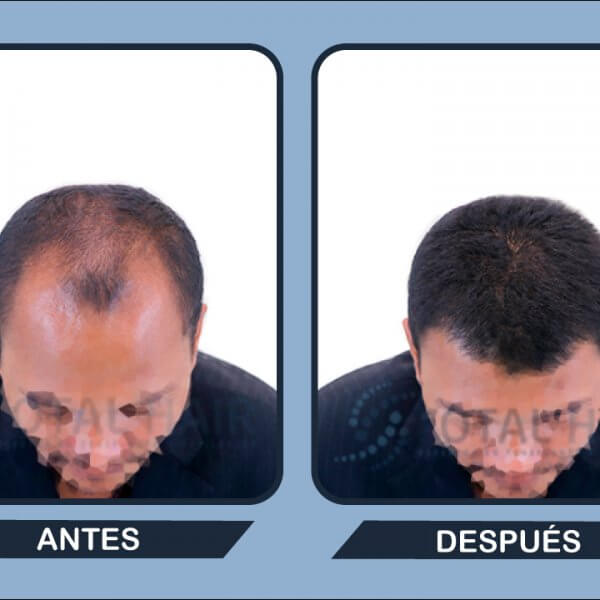 Male hair transplant results before and after patient 3