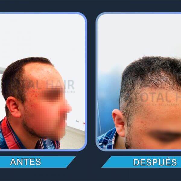 Male hair transplant results before and after patient 4