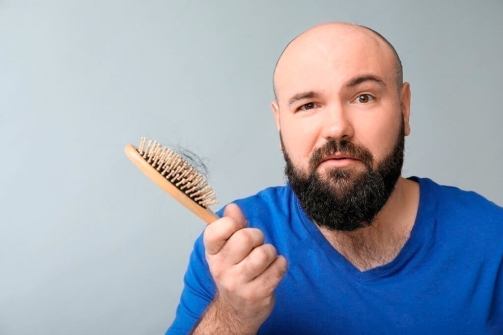 Alopecia caída del cabello y calvicie