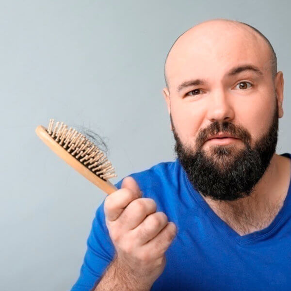 Alopecia caída del cabello y calvicie